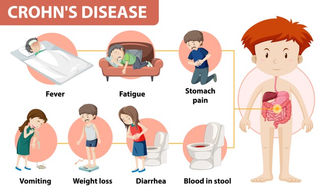 Crohn disease
